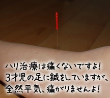 初めてのはり治療