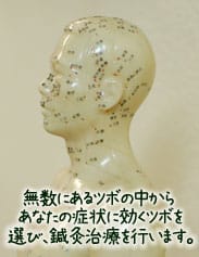 ツボへのはりきゅう治療