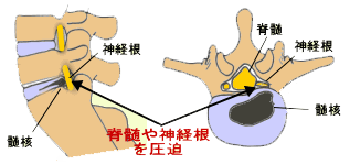 椎間板ヘルニア図