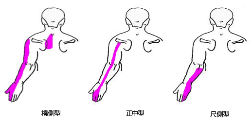 頚椎ヘルニアの症状