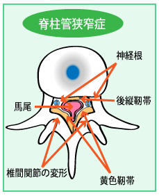 脊柱管狭窄症の図