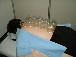 <."吸い玉治療"