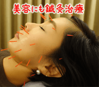 美容鍼について