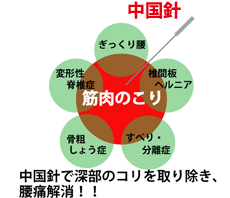 腰痛の図