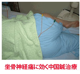 中国鍼治療