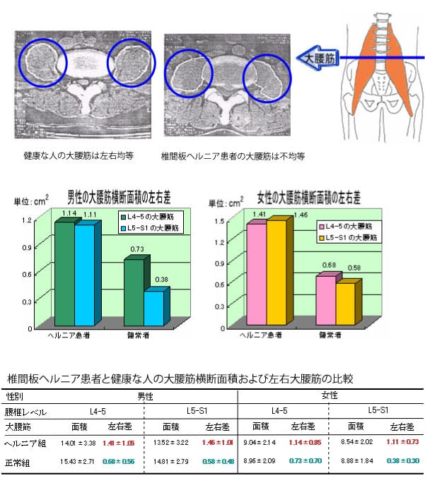 椎間板ヘルニアと大腰筋の関係