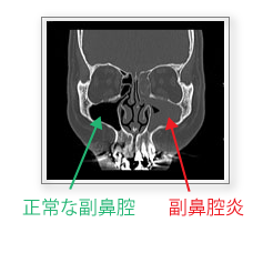 副鼻腔炎 市販薬 効果