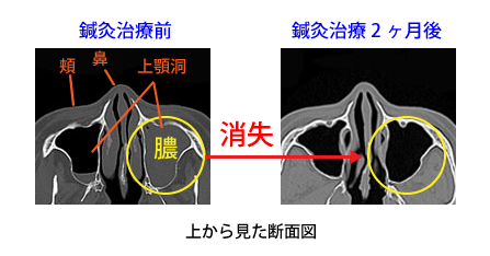 副鼻腔炎画像