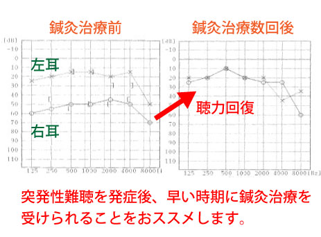 突発性難聴と鍼灸治療の開始時期