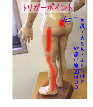 坐骨神経痛，ふくらはぎの痛みのトリガーポイント鍼治療を福岡で行っ 