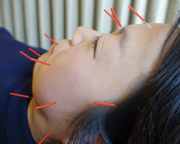 福岡のハント症候群の顔面神経麻痺の鍼灸治療