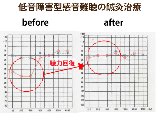 低音障害型感音難聴の鍼灸治療