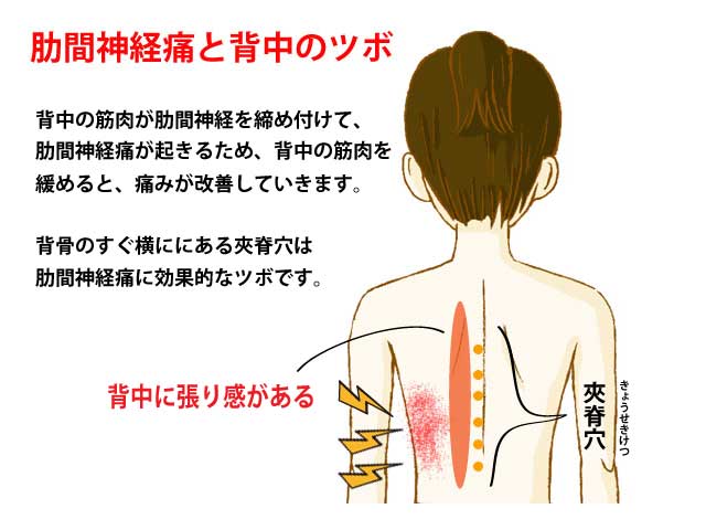 肋間神経痛