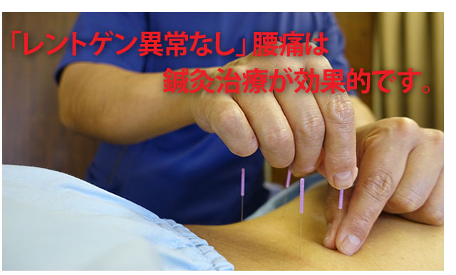 レントゲン異常なし腰痛の鍼灸治療