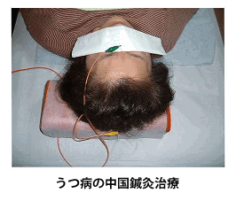 うつ病の鍼灸治療