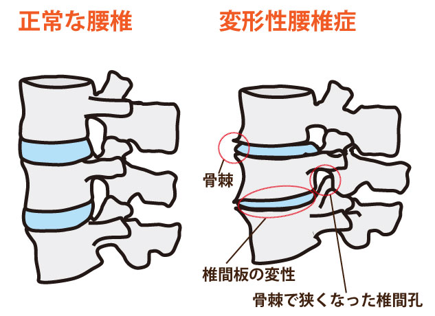 変形性腰椎症の鍼灸治療