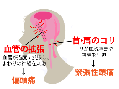 頭痛の原因図解