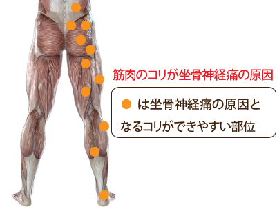 坐骨神経痛のトリガーポイント