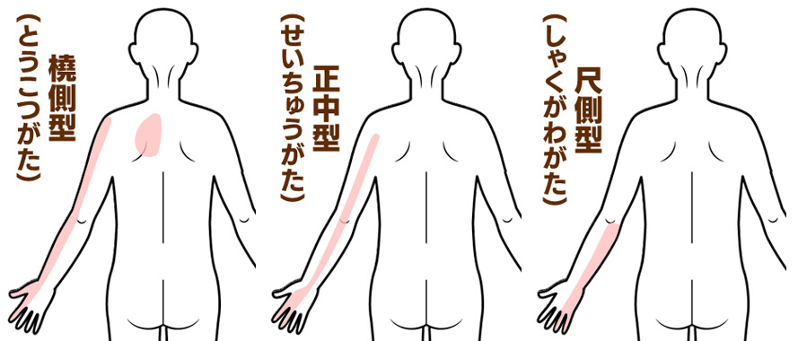 頚椎症の症状部位別