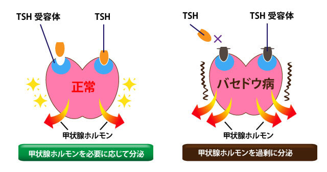 病 原因 バセドウ