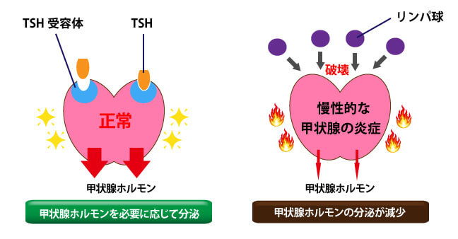 橋本病のメカニズム