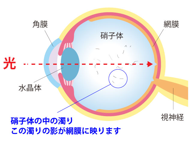 飛蚊症の原因