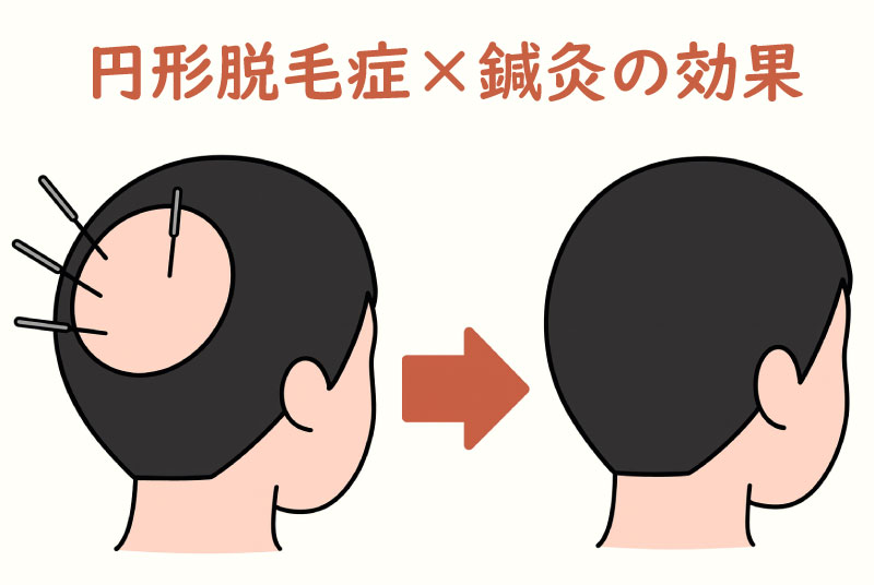 円形脱毛症に鍼が効く！？