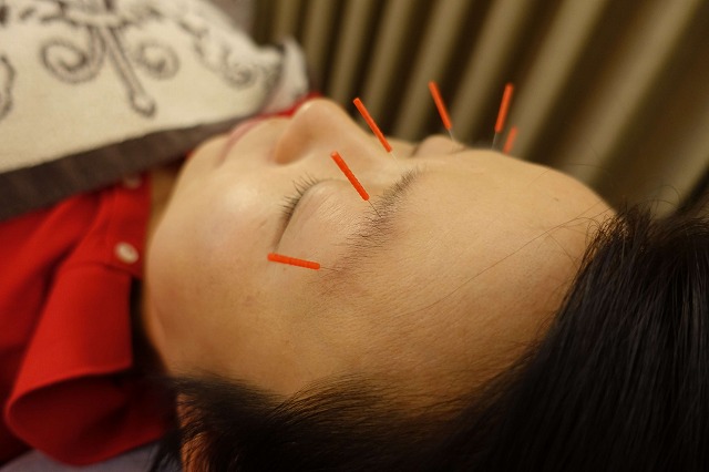 緑内障の鍼灸治療