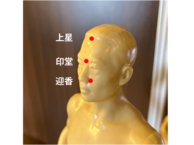 鼻炎のツボ（上星・印堂・迎香）