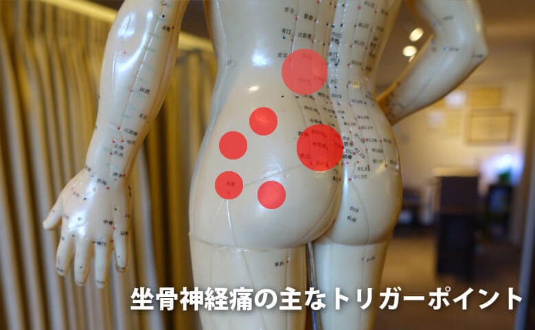 坐骨神経痛のトリガーポイント