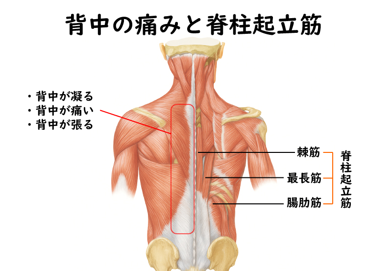 背中の痛みと脊柱起立筋
