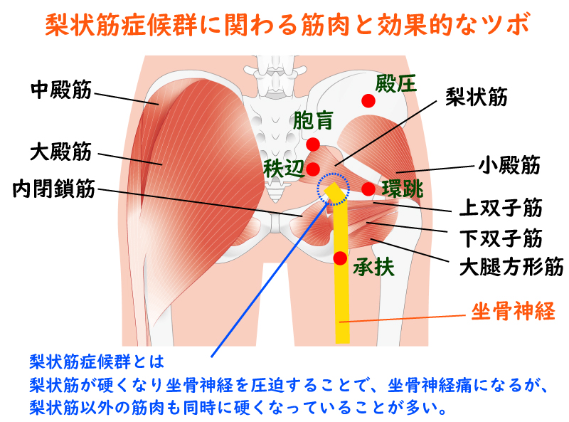 梨状筋症候群とお尻の筋肉とツボ