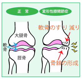 膝痛・変形性膝関節症の鍼灸治療