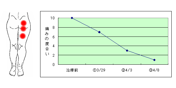 坐骨神経痛の症例2