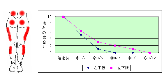 坐骨神経痛の症例1