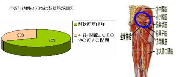 椎間板ヘルニア手術無効例の原因は梨状筋症候群