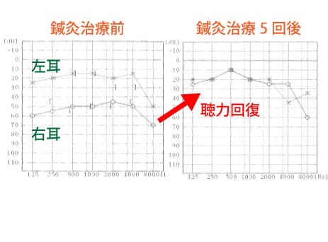 突発性難聴の鍼灸治療を福岡でお探しの方へ