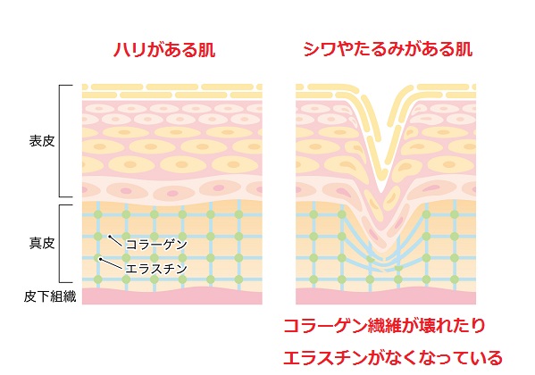 紫外線　たるみ