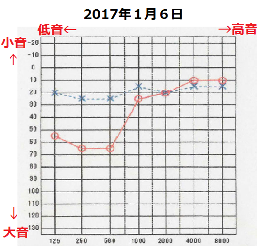 聴力1月６日2　メニエール