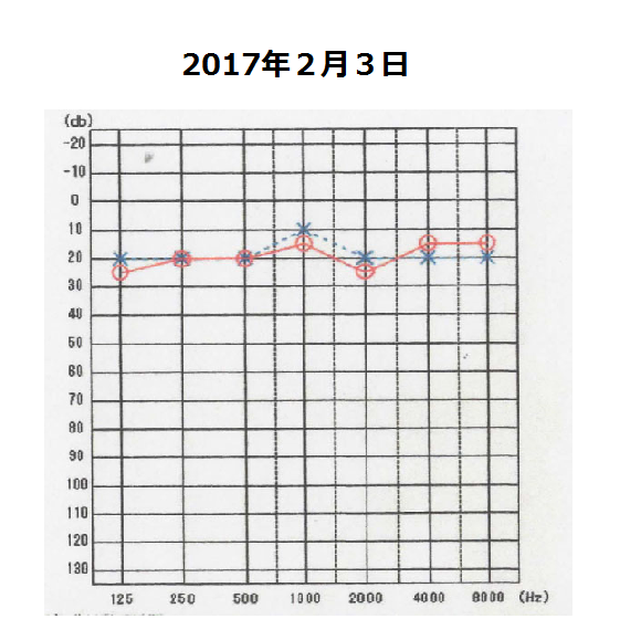 聴力2月３日　メニエール