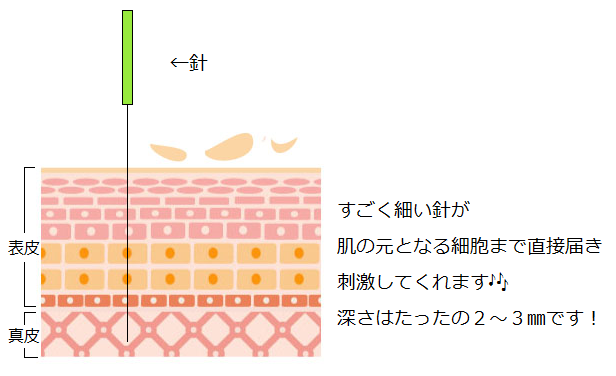 美容鍼　真皮